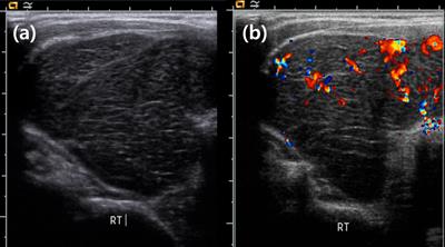 Primary thyroid lymphoma: A single-center experience